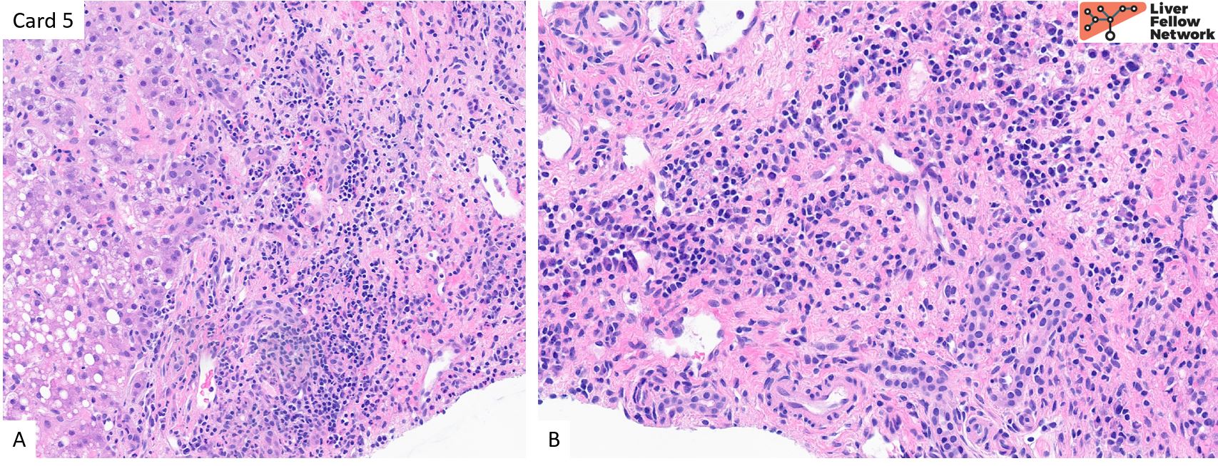 Liver Pathology | AASLD